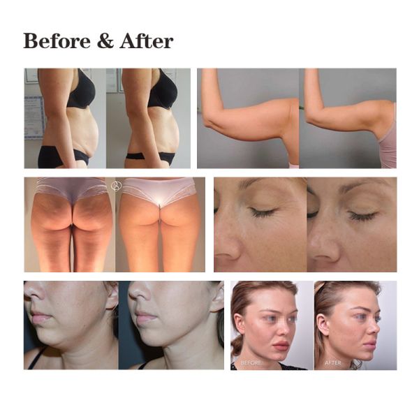 RF Vacuum LED IR body slimming machine