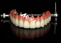 Prothèses dentaires personnalisées à l'aide d'implants dentaires, pont de couronne pour l'entretien des dents manquantes