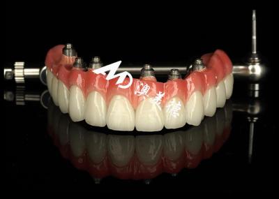 Customized Dental Implant supported dentures Crown Bridge For Missing Teeth Maintenance
