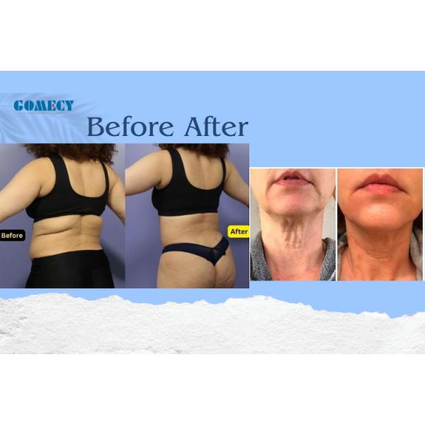 980 1470nm Dual Laser Device for Minimally Invasive Face Lift and Varicose Vein Care