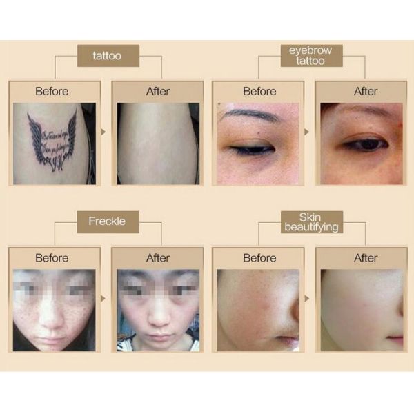 Tattoo Removal 1064nm 532nm Q Switch ND YAG Laser Machine , CE Approved