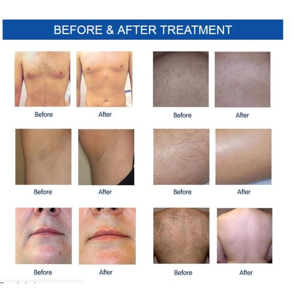 Unwanted Hair Removal Machine , Three Wavelength Non Channel Diode Laser Equipment