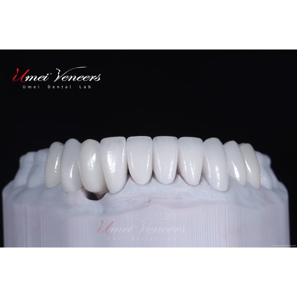 Customized ultra-thin dental veneer