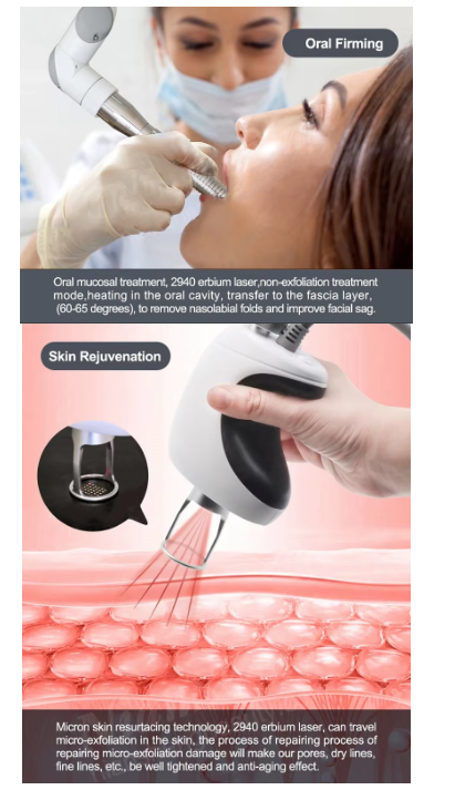 Factory Price Fotona 4D PRO 2940nm Erbium Laser +1064nm ND: YAG Laser Fotona 4D Er YAG Hair Removal