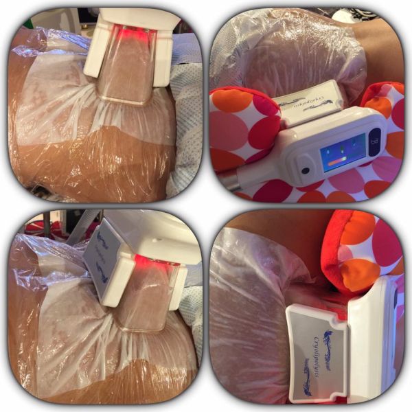 2018 High quality Four Handles Cryolipolysis treatment for Beauty salon With factory price