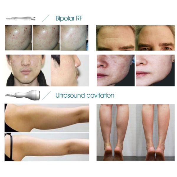 *New product looking for distributor! Hifu slimming machine