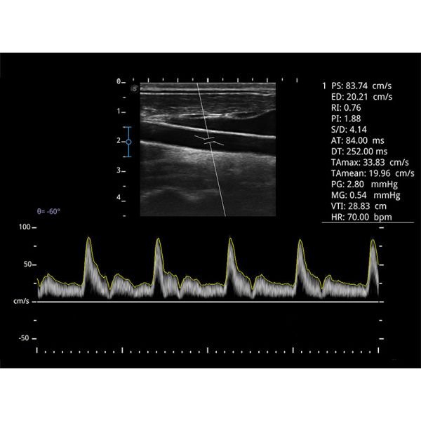 15.6 Inch LED SonoScape Portable Color Doppler Ultrasound Machine BW Ultrasound