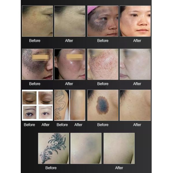 Portable Pico Laser Skin Spot Removal Machine Nd Yag Laser Tattoo Removal Machine Remove Lip Line Shrinks Pores