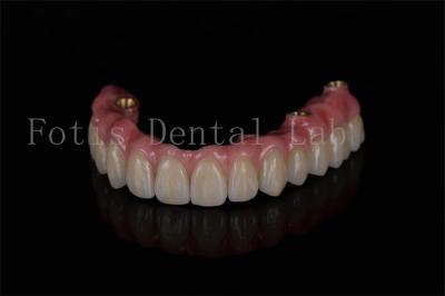Full Arch Restoration All On Four Implants For Optimal Dental Implant Performance