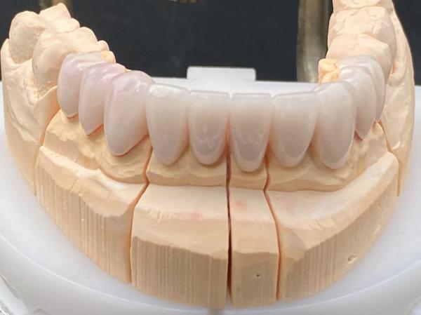 High Esthetics Dental Lab Crowns Porcelain Layered Zirconia Staining Resistance