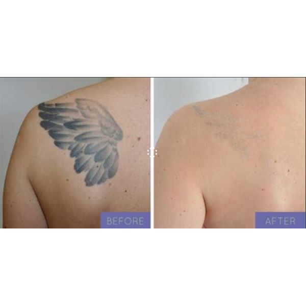 Skin Whitening Picosecond Laser Tattoo Removal Machine Easy Operation