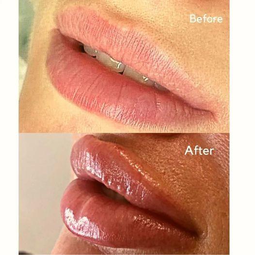 注射可能な注入口の注入Juvederms唇の容積のための超3 HAの皮膚注入口