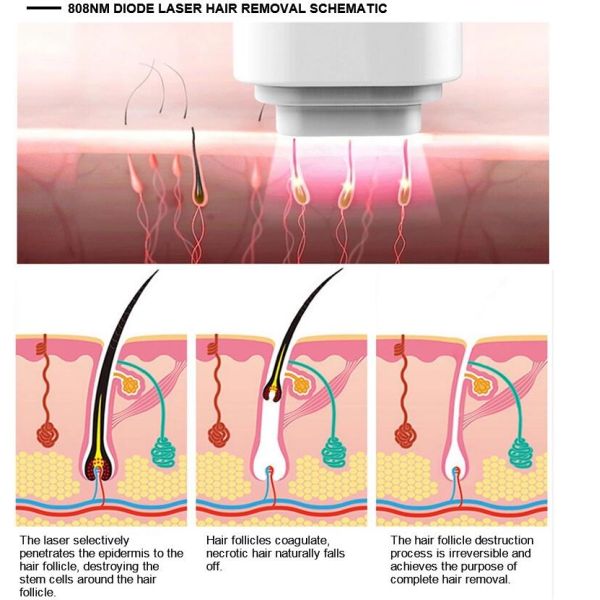 Effective Painless 808nm Diode Laser Hair Removal Machine CE / FDA Approved