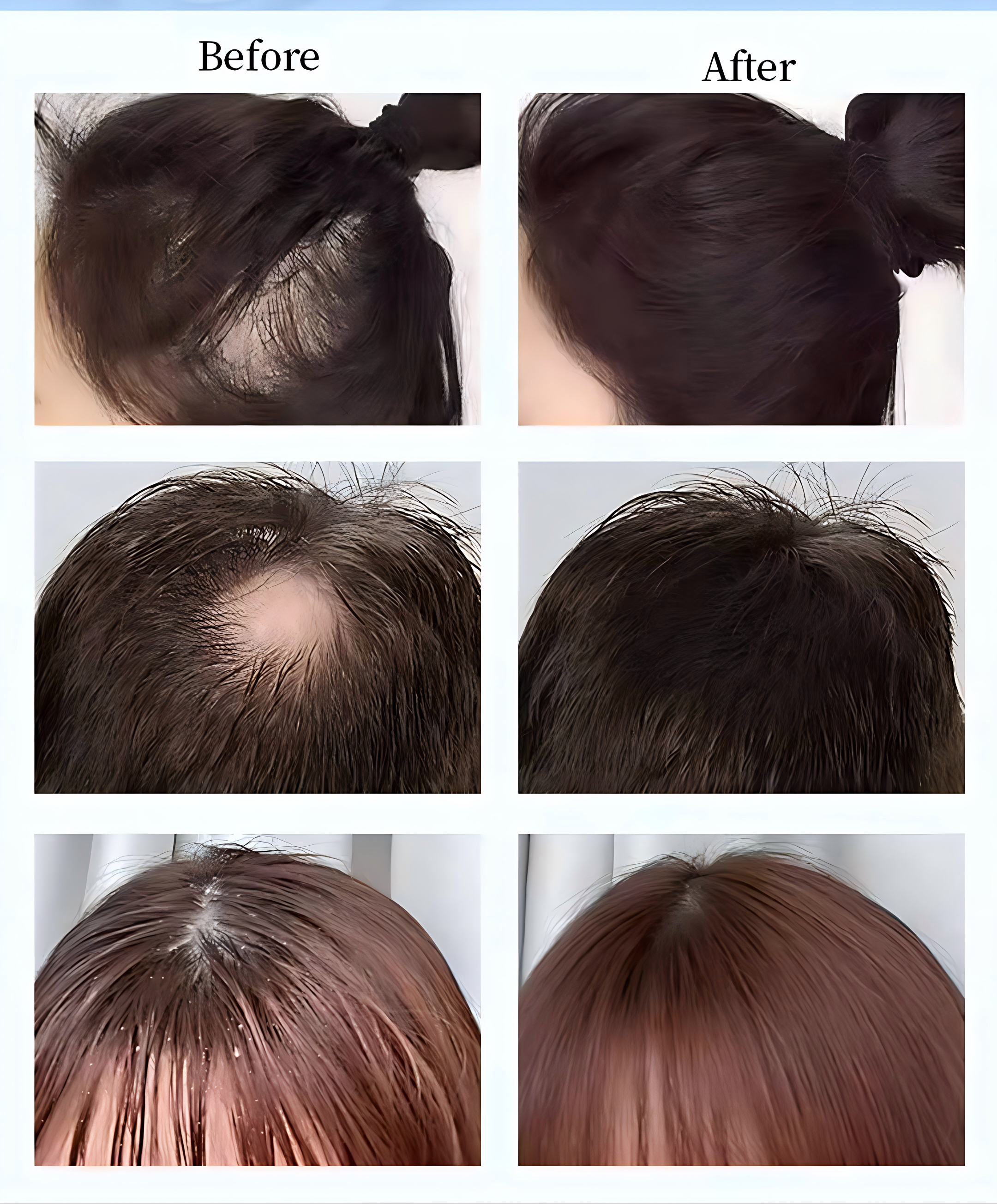Professional Hydrafacial Machine 5 In 1 Scalp Care Machine With Hair Follicle Detection