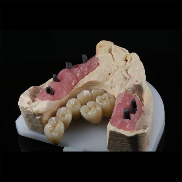 Cad Cam Implant PFM Crown Bridge Dental Medical Grade Adhesive