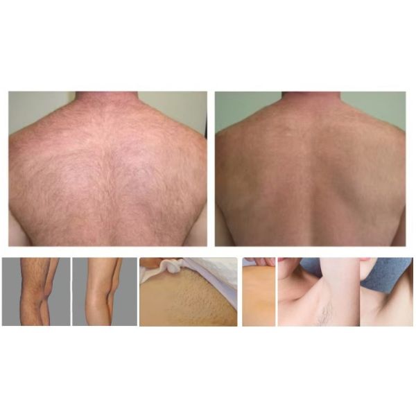 808 Диодная лазерная эпиляторная машина высокое качество Лед Платина Титан 1600W