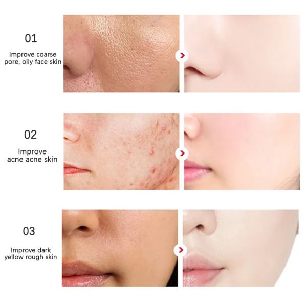 Tinta ácida salicílica de hidratación 100ML para el ODM aceitoso del OEM de la piel del acné