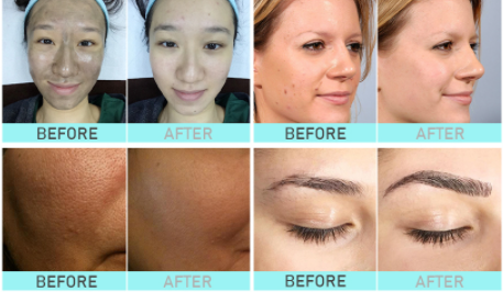 60HZ IPL Hair Removal Device Skin Rejuvenation Machine