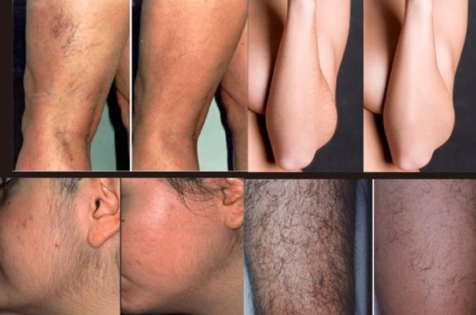 Stable Performance Laser Hair Removal Machine , 808 Laser Hair Removal Device Painless Type