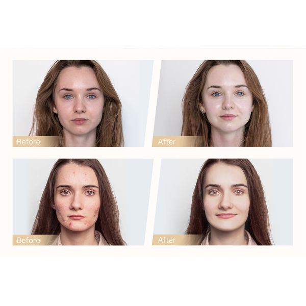 Microneedle Fractional RF Machine , Electric Microneedling Device