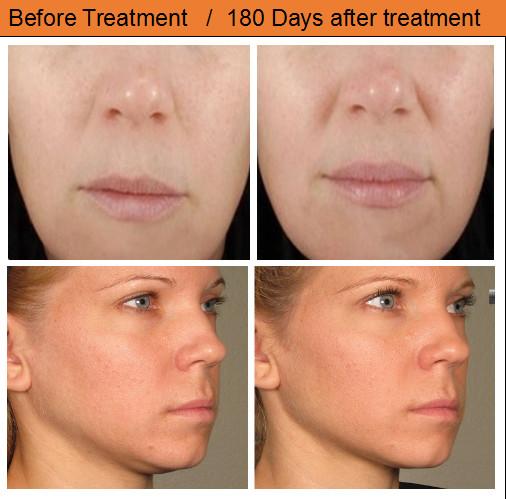 Hifu Face lifting Beauty mahcine/ hifu Face Lifting/ hifu hifu 05 face lifting