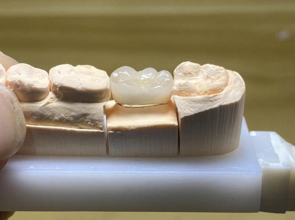 Stain Resistance PFM Ceramic Crown Adjustable With Natural Tooth Shape