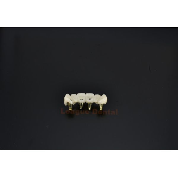 Naturally Stunning Implant Tooth Bridge Screw Retained Implant Crown Customized