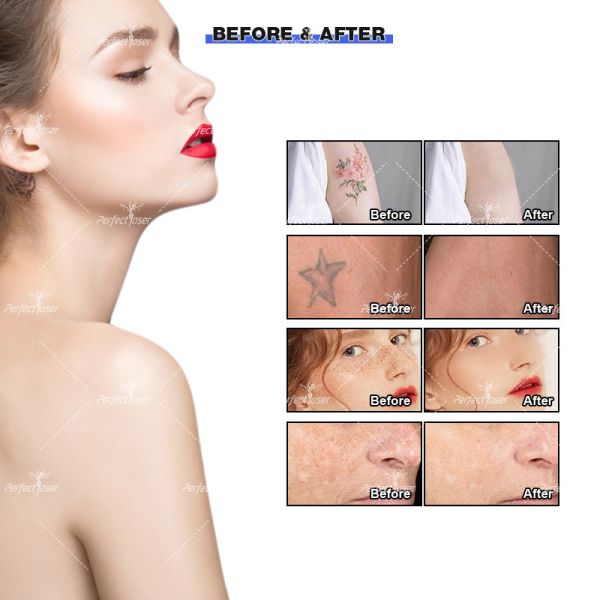 5 Probe Laser Colorful Tattoo Removal Beauty Machine Picosecond FDA CE Certified