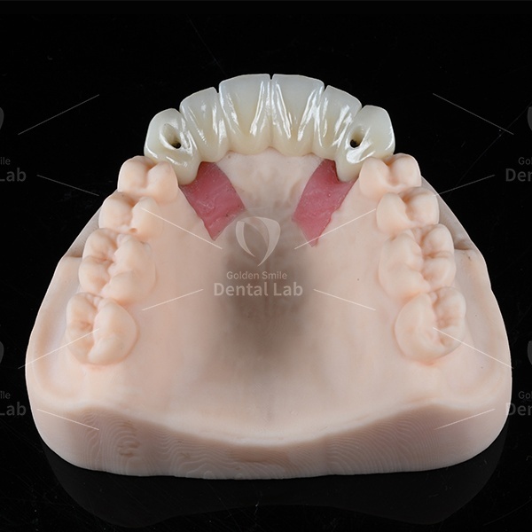 Multilayered Full Zirconia Bridge Screw Retained Bridge Customizable