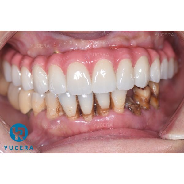 57% Translucency Cad Cam Milling Zirconia Blank Multilayer Block