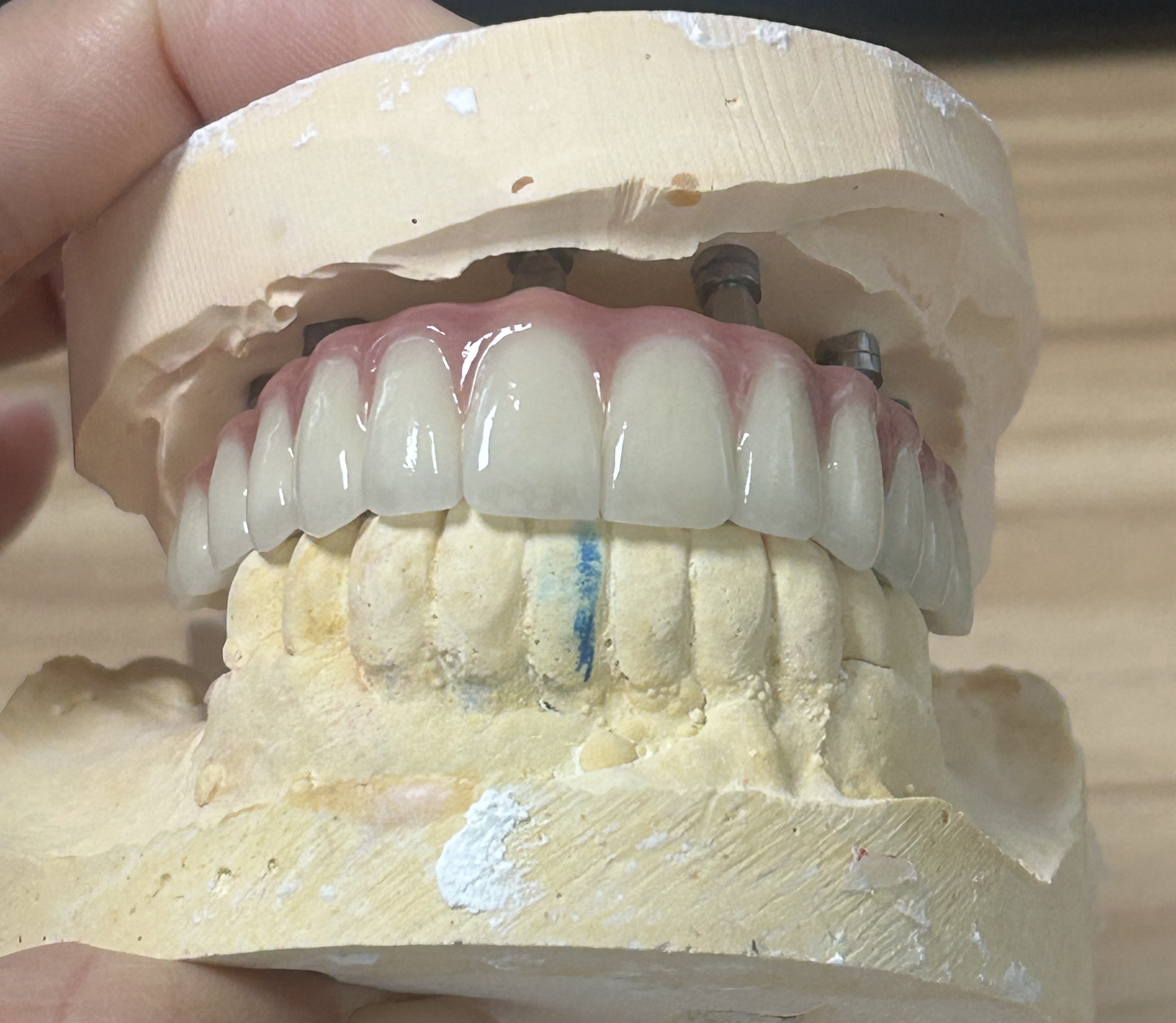 High-Strength Dental Zirconia Implant Crown with Natural Translucency & Tooth-Like Appearance via Digital CAD/CAM