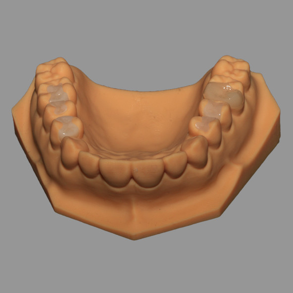 Full Ceramic Dental Emax Inlay Onlay Crown Pressed / Milled