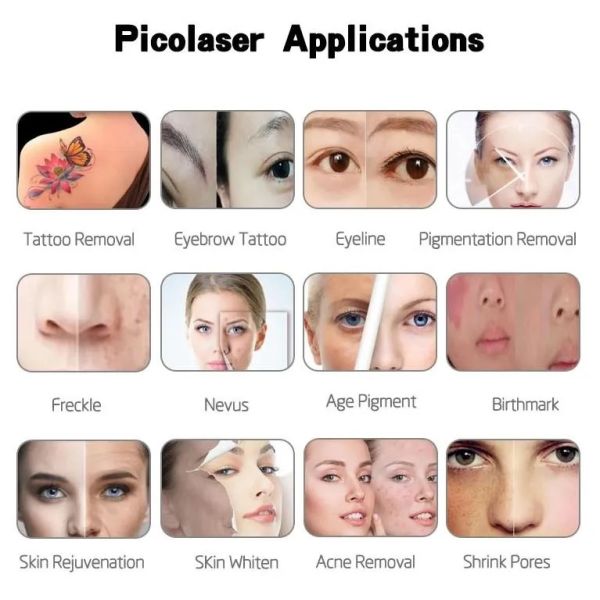 532nm 755nm 1064nm Vertical Q Switch Picosecond Laser para la eliminación del acné