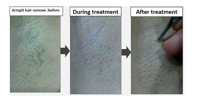 ISO HR SR IPL Skin Rejuvenation Machine SHR Hair Removal Device