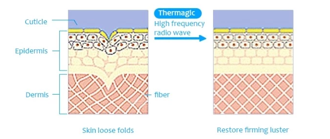 Anti aging Acne Removal Color Screen Thermagic RF Beauty Machine For Salon