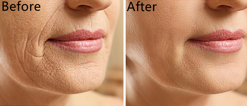 Заполнитель увеличения 5ml Derm впрыски губы дермальный для сыворотки заботы кожи носа Chin