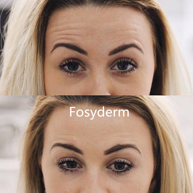 Jeringuilla cutánea del ácido hialurónico de la inyección 2ml del llenador del cuidado personal de la cara de Fosyderm