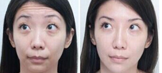 Увеличение губы заполнителя 1ML Skinject Hyaluronic кисловочное дермальное лицевое заполняя