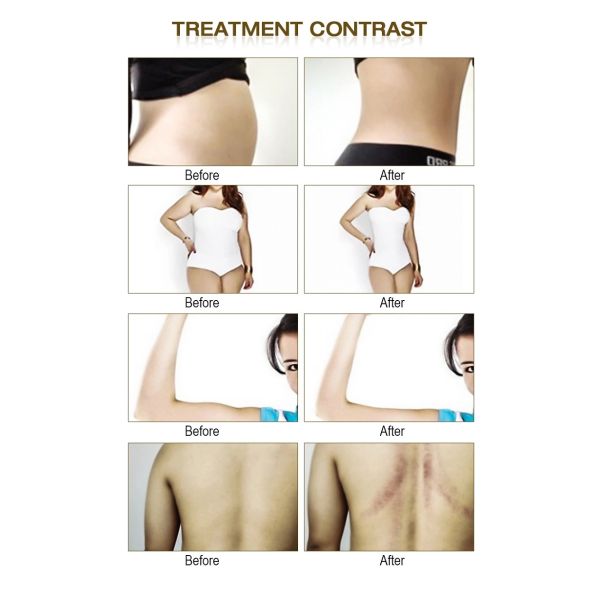 Portable 75W Black Color Body Massager Cavitation Vacuum Slimming Weight Loss Machine