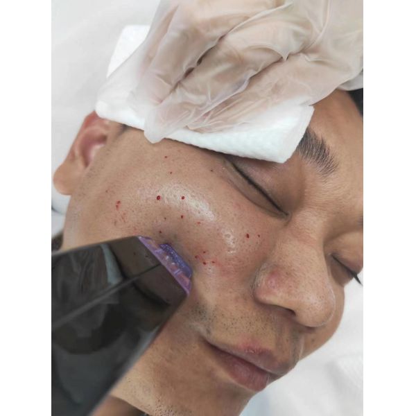 Morpheus 8 Skin Tightening Microneedle Fractional RF Machine 300W