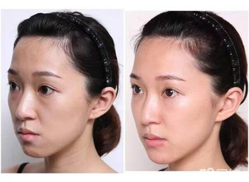 Remplisseur cutané d'acide hyaluronique profond de la certification 1ml d'OIN de la CE pour remplir de lèvres