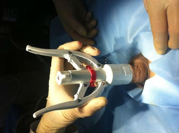 Circular Visual Circumplast Circumcision Device Disposable For Male