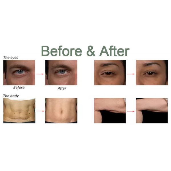 Приборы RF Microneedling машины красоты MRF SRF 200W частичные RF