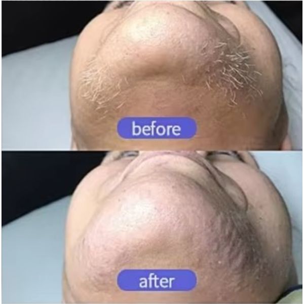 Пико лазерная эпиляция вертикальная 808 диодная лазерная эпиляция машина 2 в 1