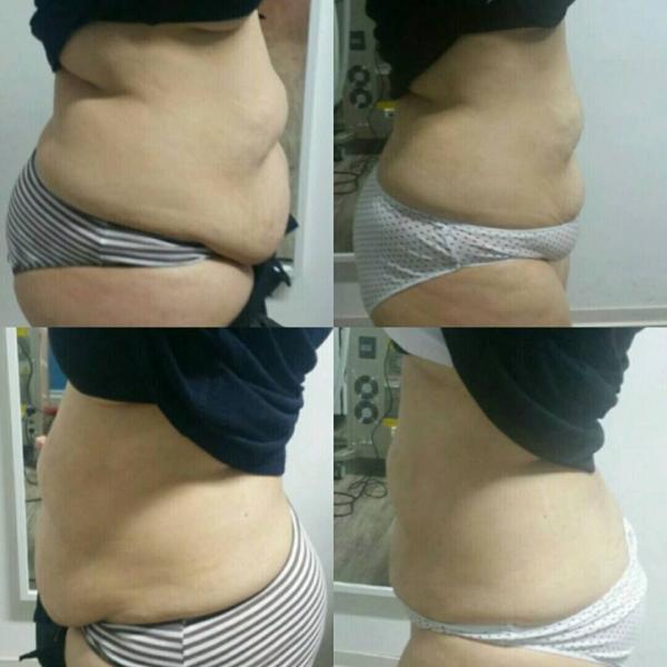 Fat And Cellulite Removal Machine Weight Loss Fat Belly Burning Rf Skin Tightening