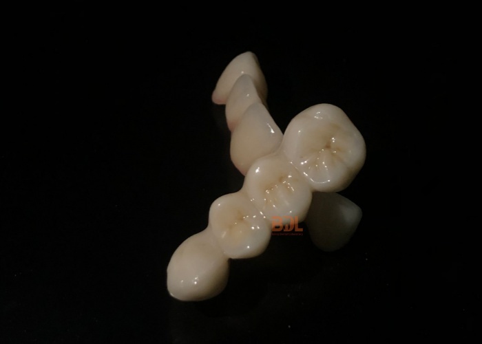 Durable Ceramic Dental Prosthesis Custom Made Precision Engineered Solutions for Dental Laboratories and Clinics
