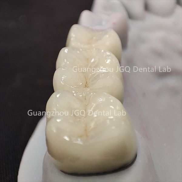 Custom China Dental Laboratory Zirconia Crown Bridge for Global Clinics
