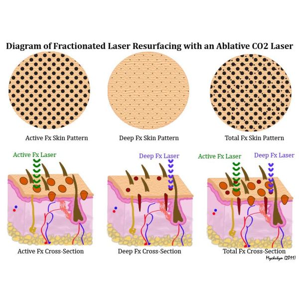 Medical equipment CO2 fractional laser stretch marks device price for aesthetic equipment
