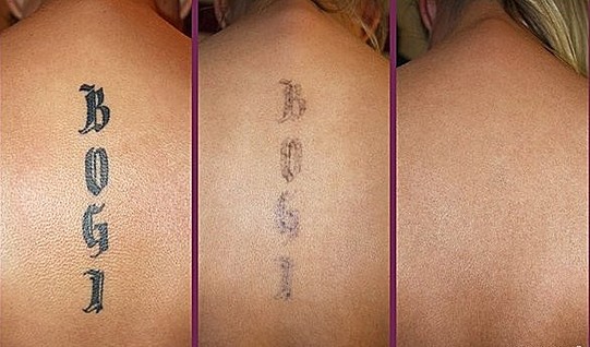 Tattoo ink removal Q Switched ND-yag Laser Machine