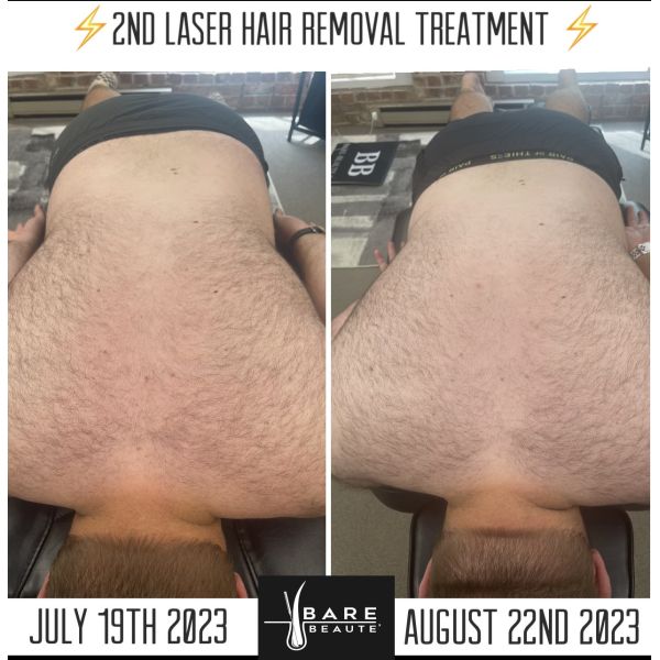 Двойная ручка Сопрано Титановый лазерный косметический аппарат 4k Удаление волос 1200W 12 Бар диод